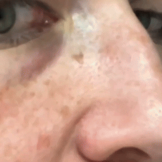 SkinSweep Blackhead Patche