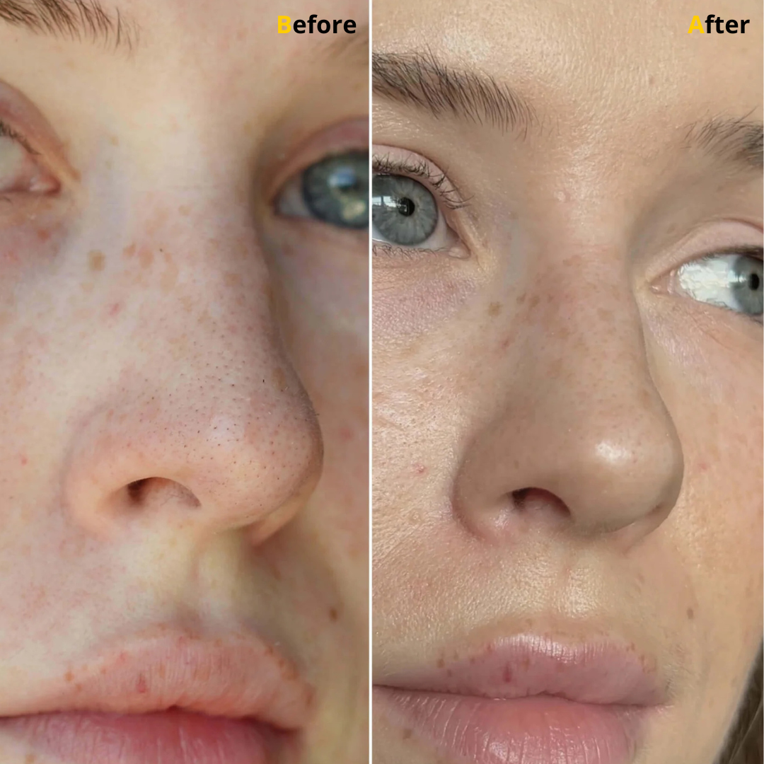 SkinSweep Blackhead Patche